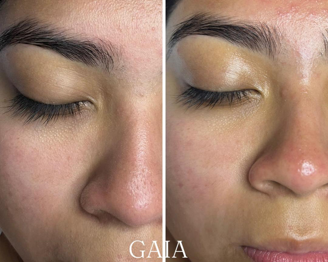 Limpieza Facial Profunda