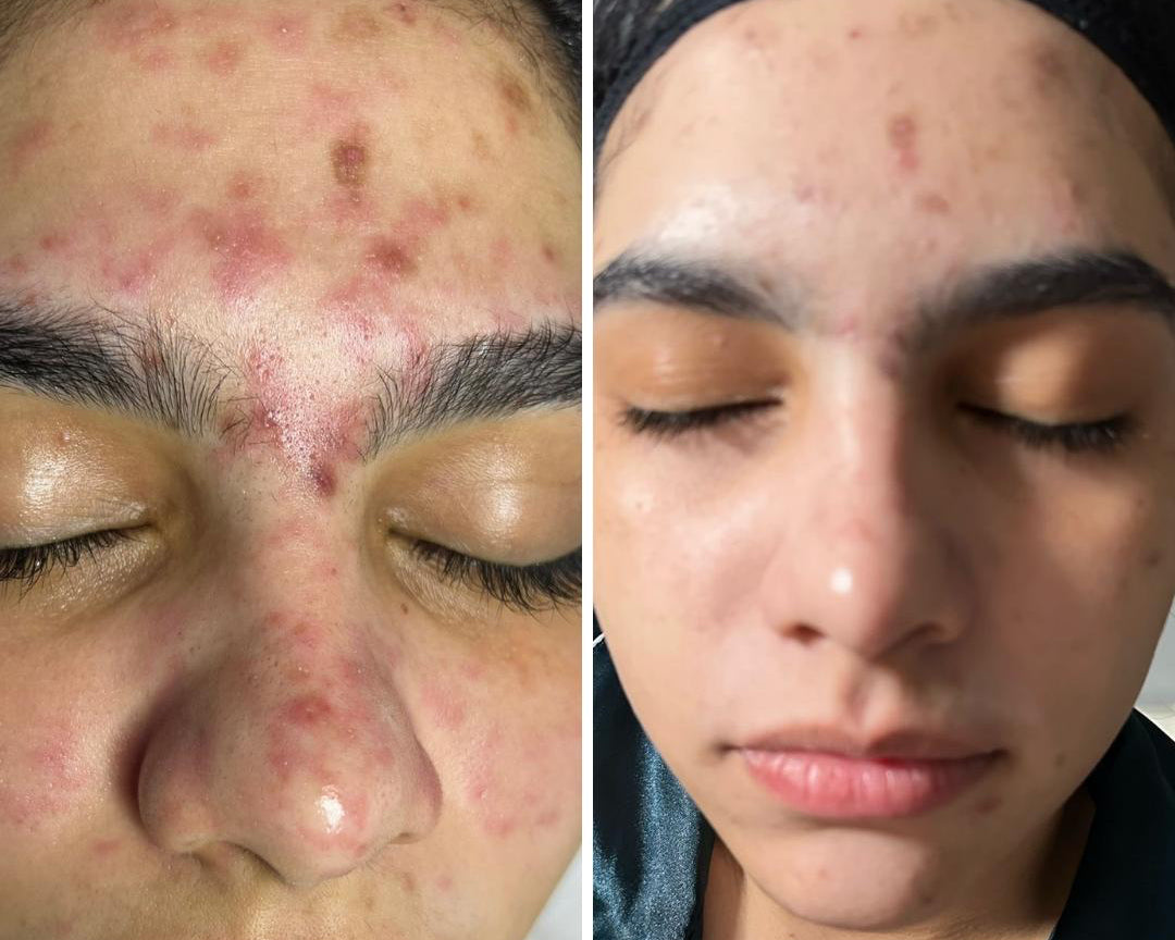 Tratamiento para Acne Activo